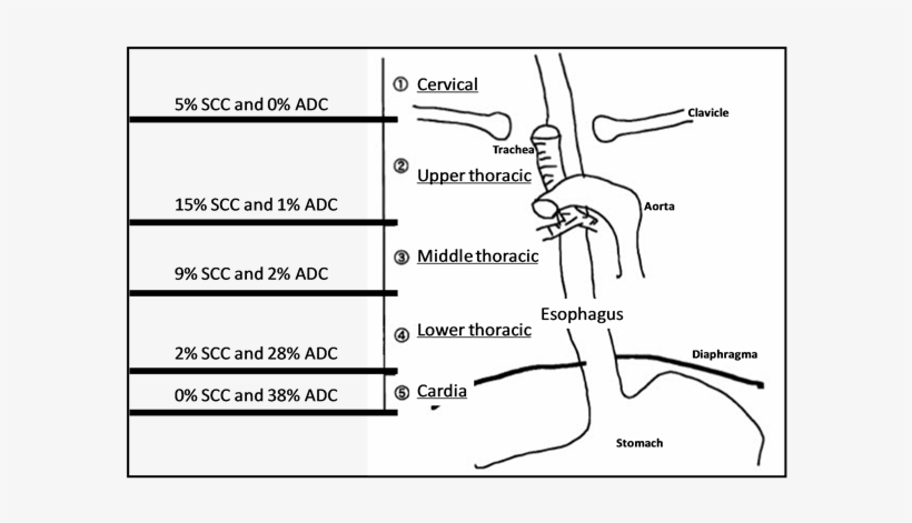 Incidence And Location Of The Two Types Of Esophageal - Diagram, transparent png