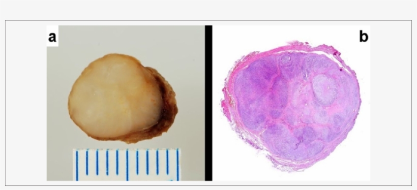 A) Tumor Is Solid, Well Circumscribed, And Yellow Tan - Lobulation, transparent png