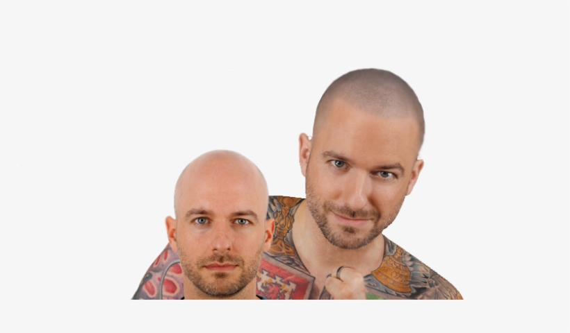 Bald - Hair Loss, transparent png
