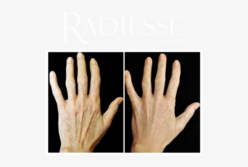Before And After Treatment With Radiesse® Hands - Thermage Hands Before After, transparent png