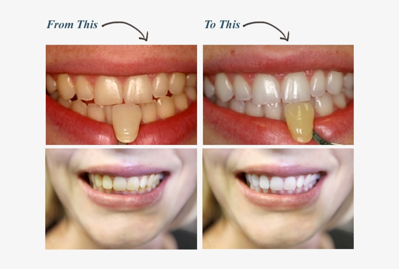 White Teeth Png - Do I Whiten My Teeth, transparent png