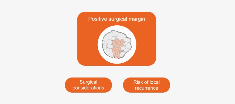 Partial Versus Radical Nephrectomy Oncology - Parallel, transparent png