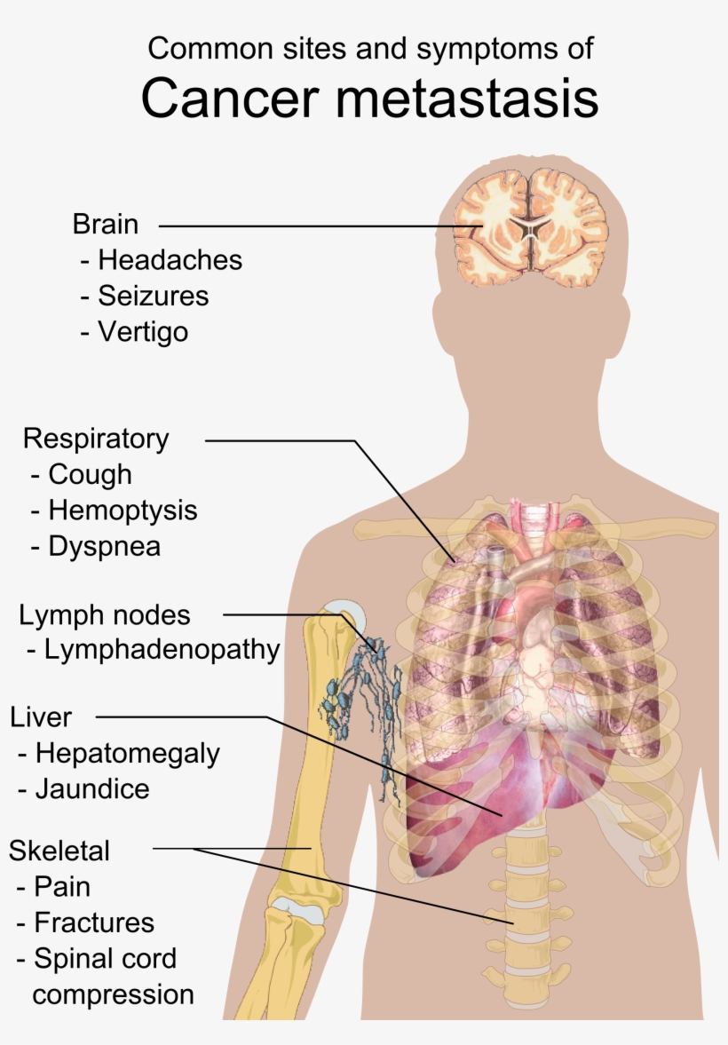 Symptoms Of Cancer Metastasis, transparent png
