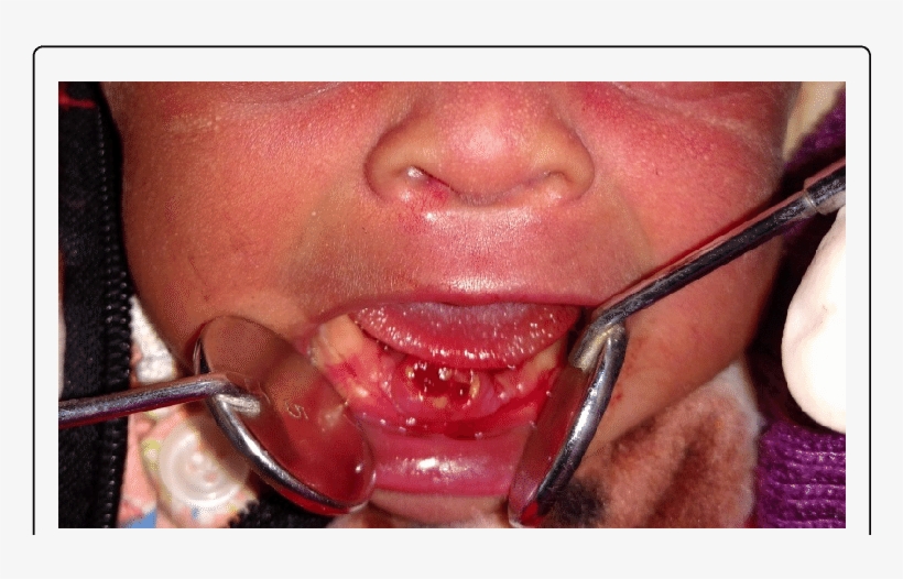 Extracted Natal Teeth Resembling Immature Teeth Download, transparent png