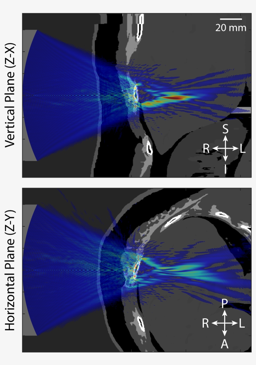 Ultrasound Beam Distortion, transparent png