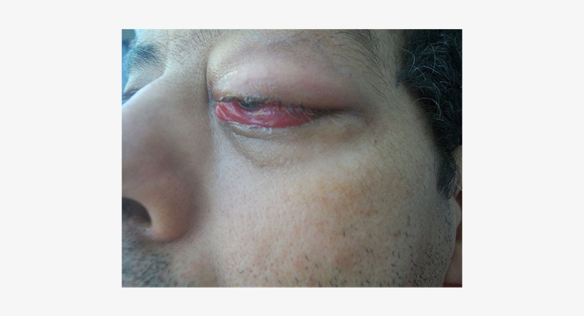 Orbital Abscess Secondary To A Left Frontal Sinusitis, transparent png