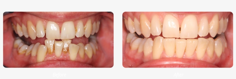 Fast Braces 4 Months, transparent png