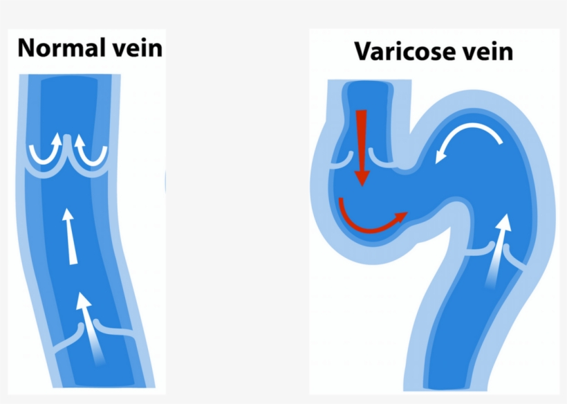 Get Rid Of Varicose Vein Symtoms By Dr - Vein, transparent png