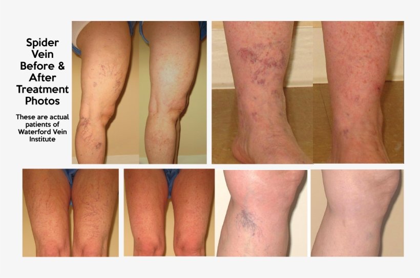Spider Veins - Scar, transparent png