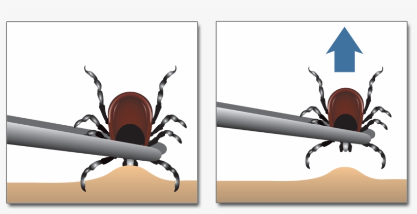 You Found A Tick Now How Do You Get Rid Of It Learn, transparent png