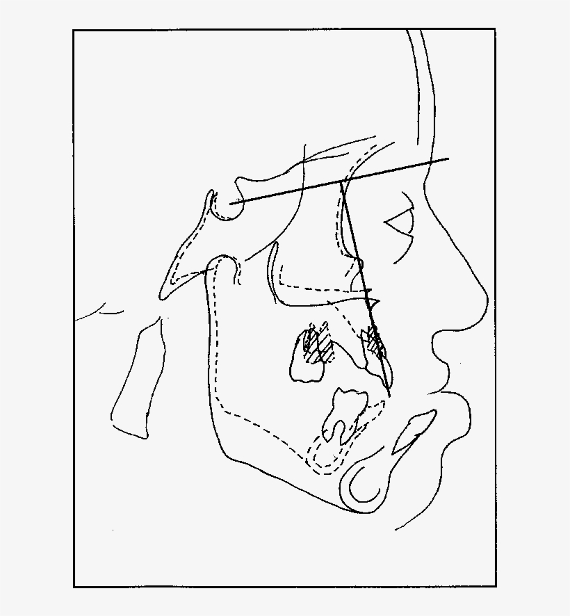 Showing Postsurgical Growth Of, transparent png