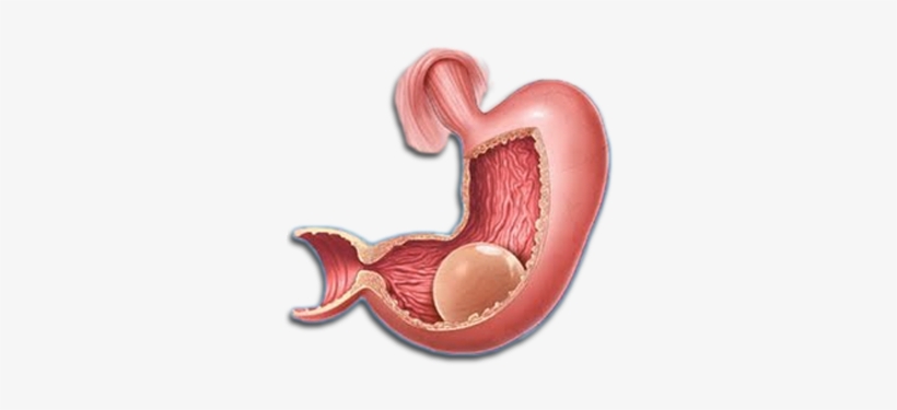 Gastric Balloon, transparent png