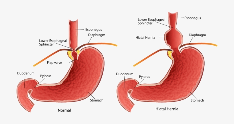 Our Stomach Is An Amazing Organ But It Has An Achilles - Hiatal Hernia, transparent png