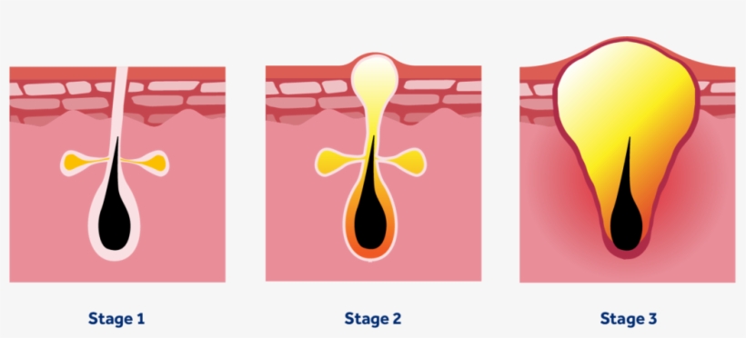 Different Grades Of Acne, transparent png