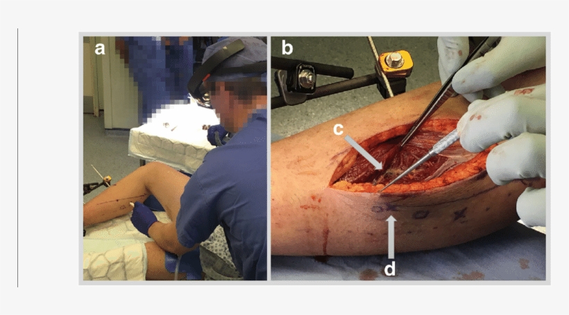 A Case 5 Marking Of Skin Under Hololens Guidance, transparent png