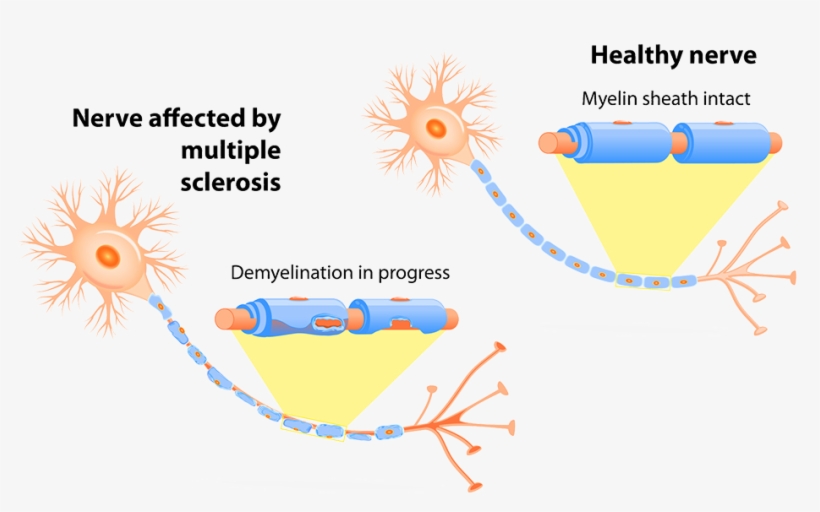 Multiple Sclerosis, Ms, Dubai, transparent png