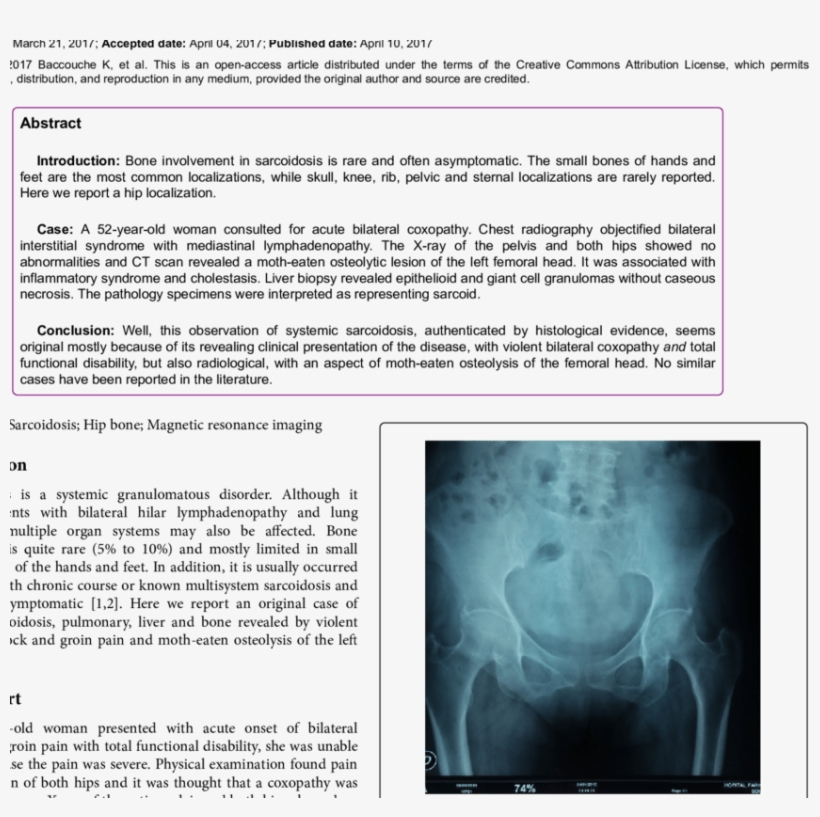 X-ray Of The Entire Pelvis And Both Hips Showed No, transparent png