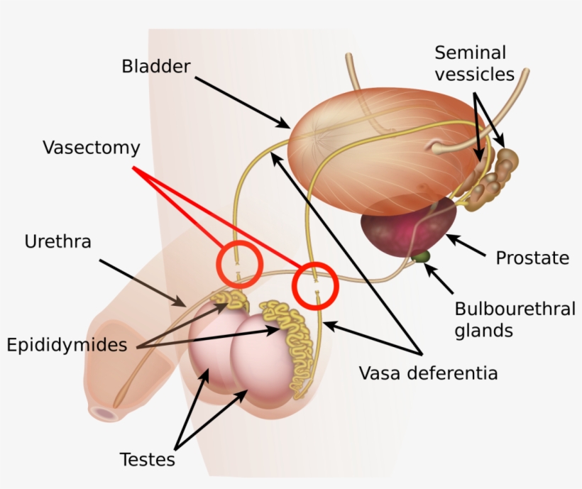 Male Sterilization, transparent png