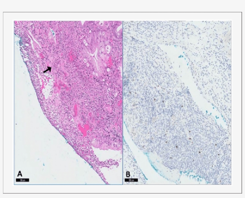 Biopsy Result Of Suspicious Gastric Mass Revealed Multiple, transparent png