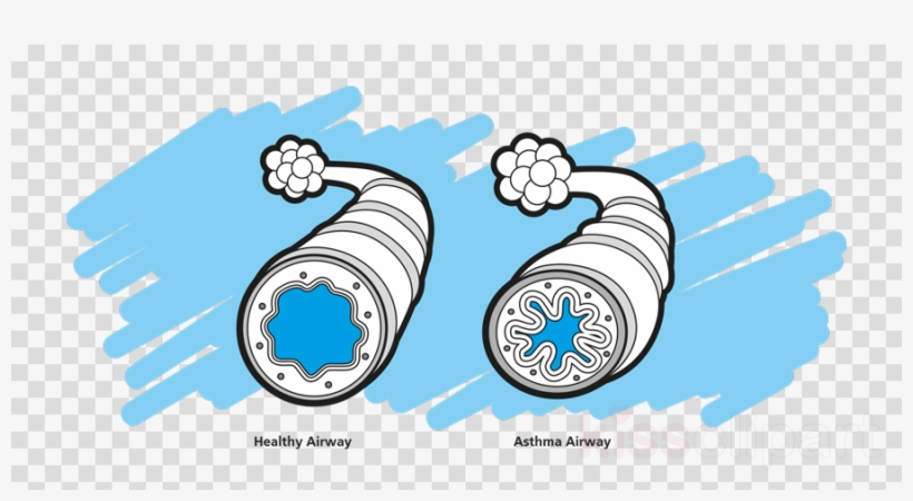 Asthma Png Clipart Asthma Spacer Respiratory Tract, transparent png