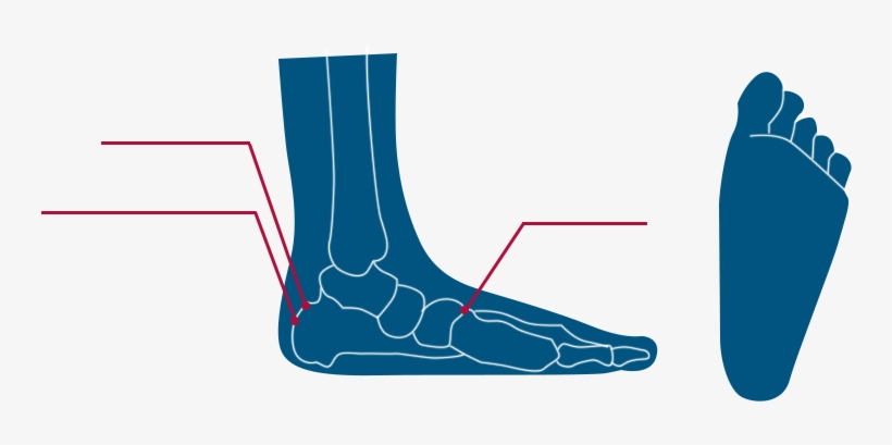 Types Of Flat Foot, transparent png