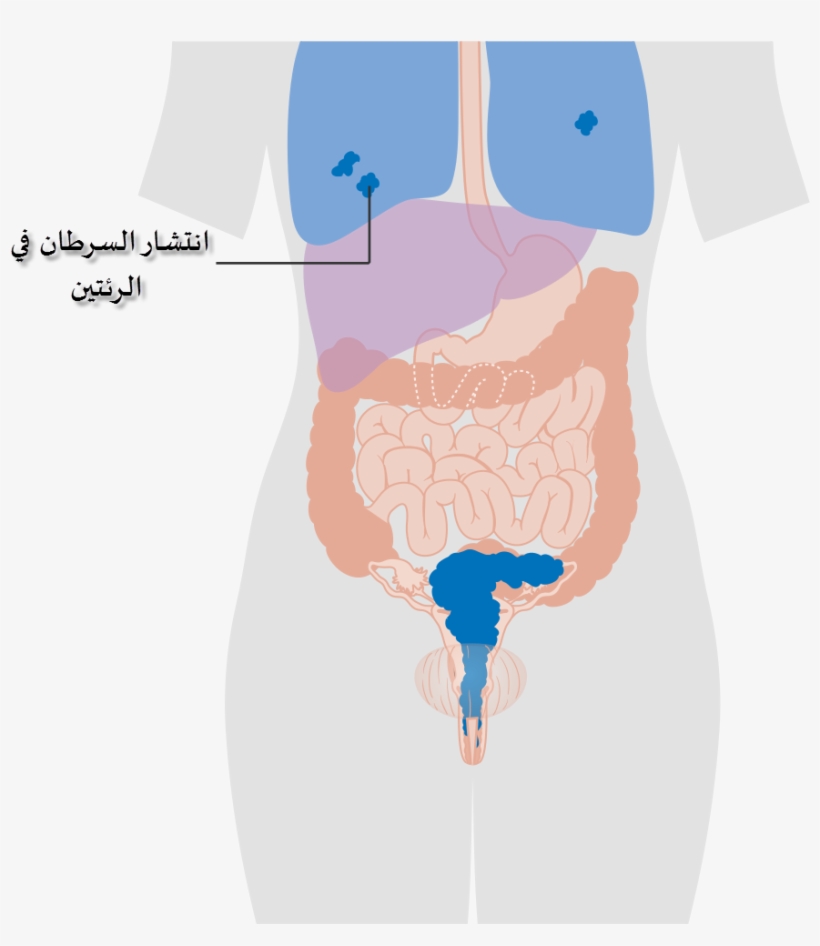 Diagram Showing Stage 4b Cervical Cancer Cruk 239-ar, transparent png
