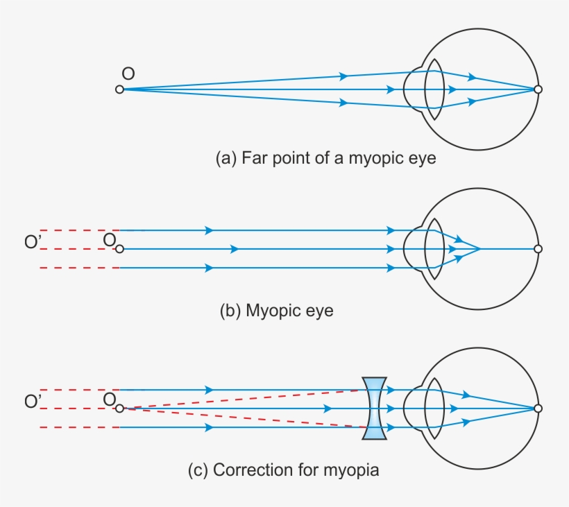 Hypermetropia Or Far Sightedness - Curvature Of The Eye Lens, transparent png