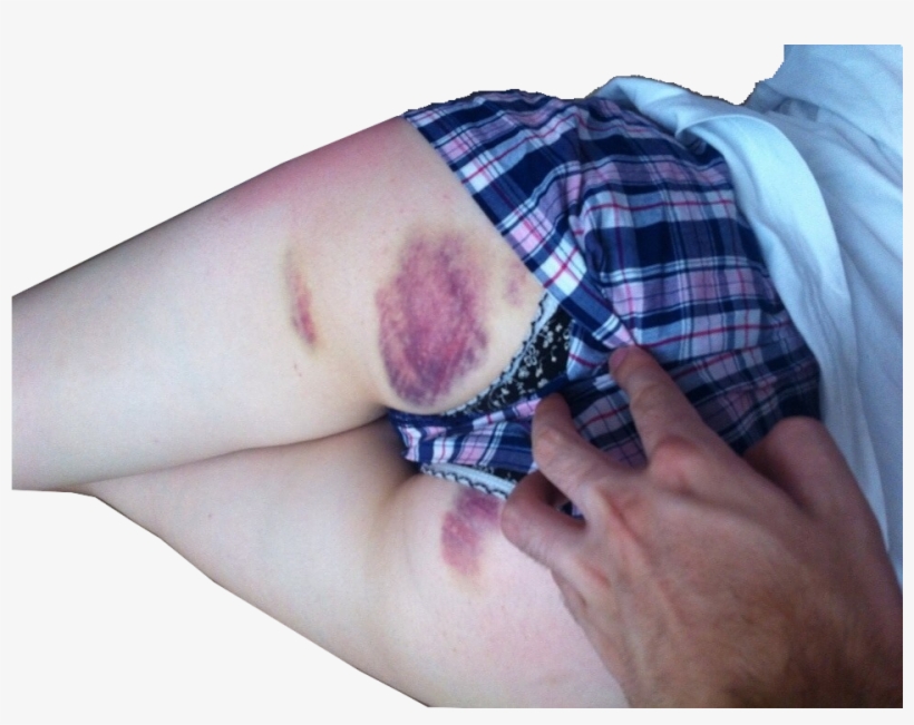 #transparent #ass #bdsm #nsfw #spanking #bruisespic, transparent png