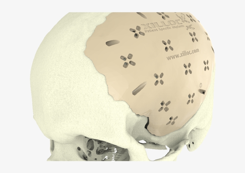 Cranial Implant - Implant, transparent png