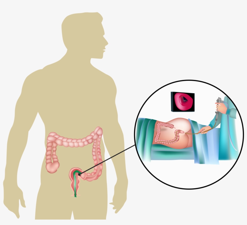 A Flexible Sigmoidoscopy Is A Procedure That Examines - Sigmoidoscopy, transparent png