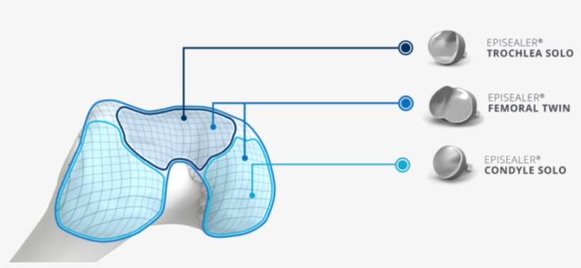 Episurf Medical Reaches Milestone Of 300 Implants - Diagram, transparent png