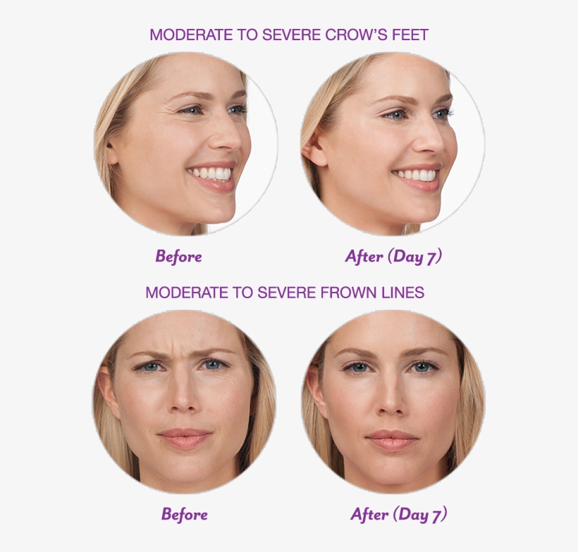 We Now Offer Botox Do You Have Crow's Feet Or Frown - Botox For Smile Lines, transparent png