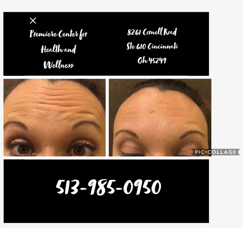 How Does Botox® Work, transparent png