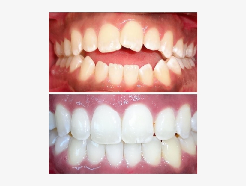 Invisalign Before And After - Dentures, transparent png