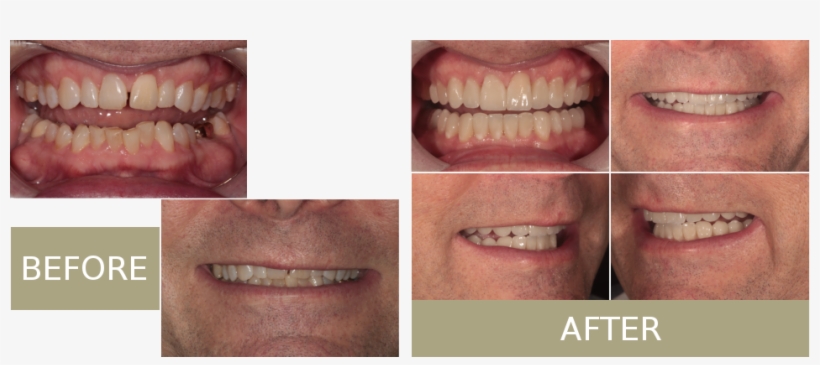 Jon Came To Us Upset With The Way His Smile Presented - Tongue, transparent png