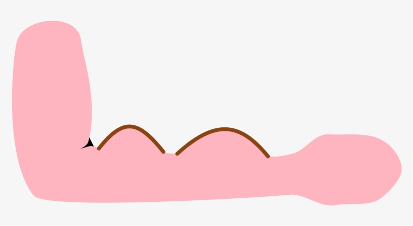 Dialyse Shunt Arm, transparent png