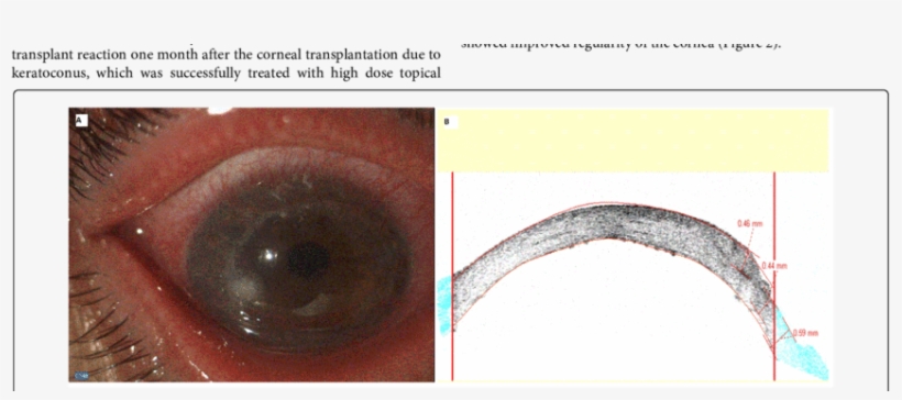 Fungal Keratitis In A Corneal Graft - Fungal Keratitis, transparent png