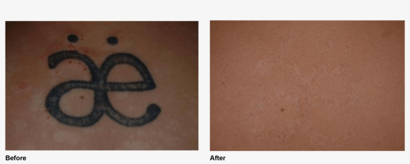 Tattoo Removal, transparent png
