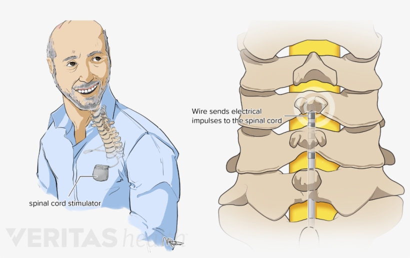 Spinal Cord Stimulators And Pain Pumps - Cartoon, transparent png