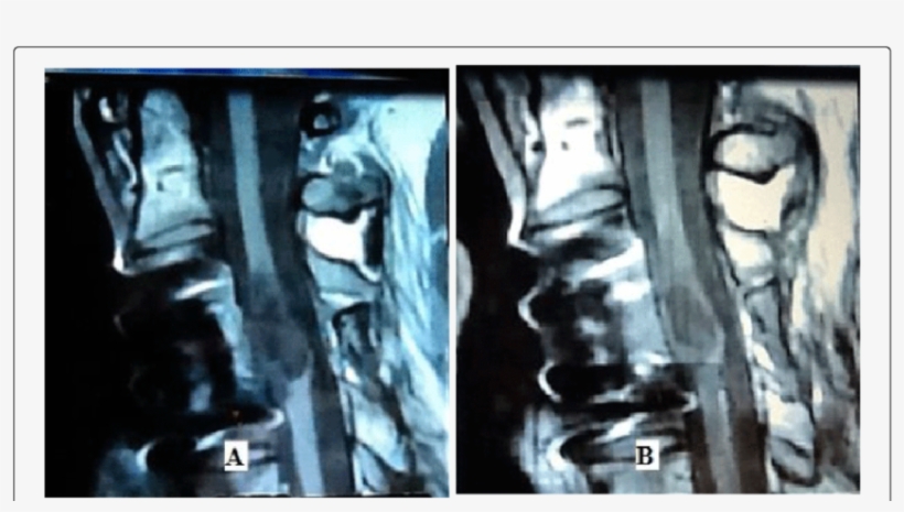 Tractographic Images Of Spinal Cord Of A Patient With - Visual Arts, transparent png