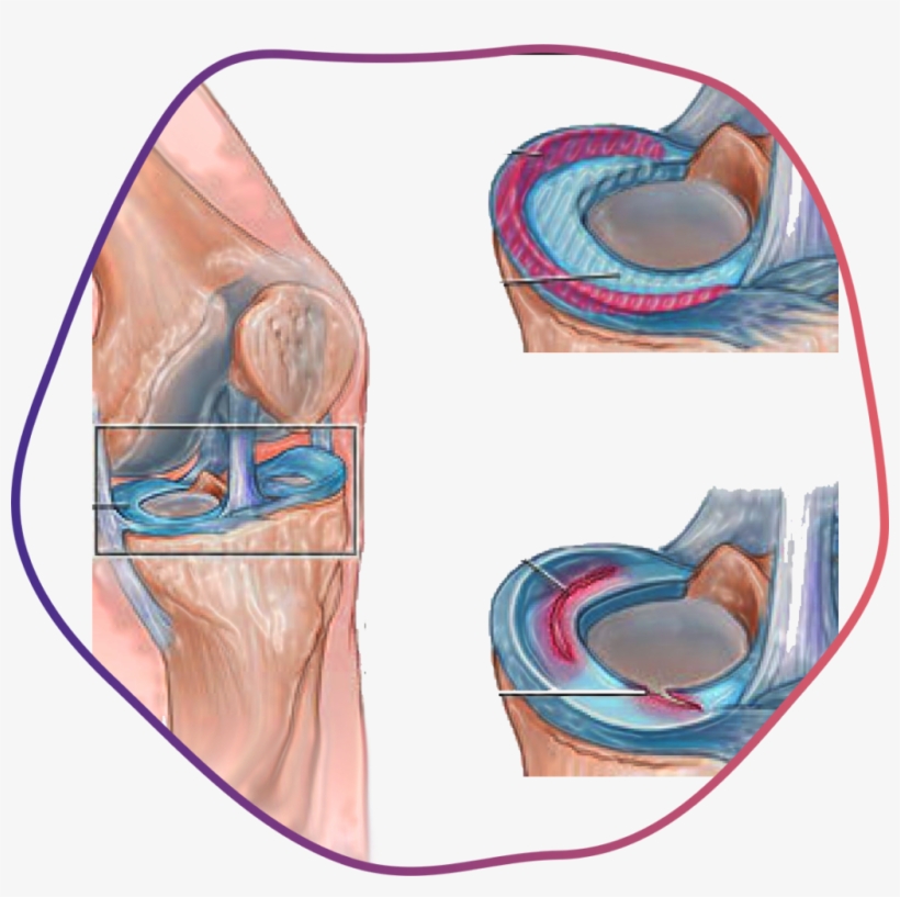 Ligament & Cartilage Tears - Illustration, transparent png