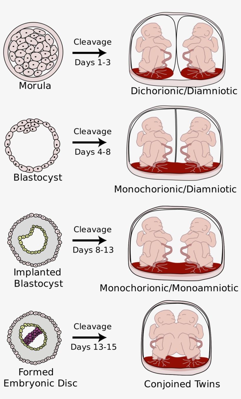Monochorionic Twins, transparent png