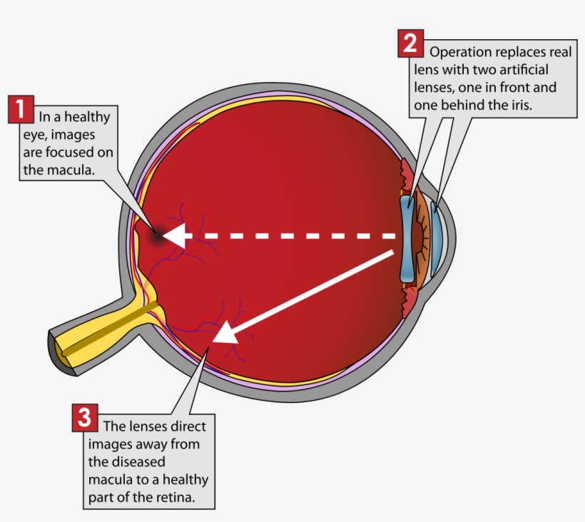 Iolvip - Implantable Miniature Telescope Diagram, transparent png