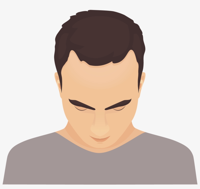 Phase 1 Of Baldness Is Recognized By The Presence Of, transparent png