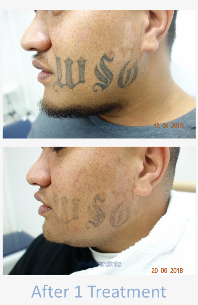 Facial Tattoo Removal - Poster, transparent png