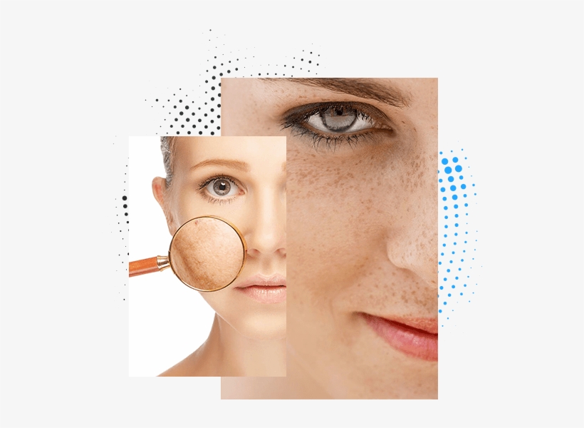Manchas En La Piel - Veet Skin Discoloration, transparent png