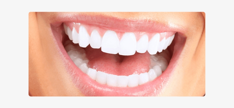 White Teeth - Does Straight Teeth Look Like, transparent png