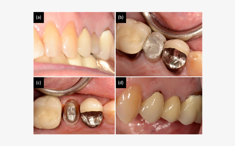Patient Complained About The Second Premolar Tooth - Tongue, transparent png