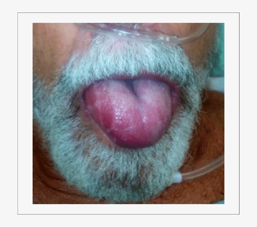 Rapidly Progressive Angioedema To The Tongue - Cat Yawns, transparent png