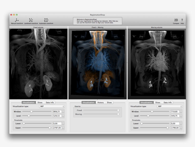 1003-10arterialvenousmip [795ko] - Computed Tomography, transparent png